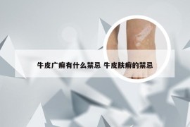 牛皮广癣有什么禁忌 牛皮肤癣的禁忌