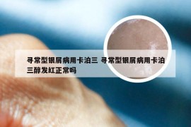 寻常型银屑病用卡泊三 寻常型银屑病用卡泊三醇发红正常吗