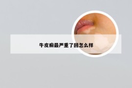 牛皮癣最严重了回怎么样