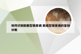 如何识别脓胞型银屑病 脓疱型银屑病的鉴别诊断