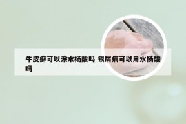 牛皮癣可以涂水杨酸吗 银屑病可以用水杨酸吗