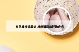 儿童丘疹银屑病 丘疹银屑病好治疗吗