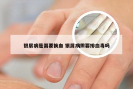 银屑病是需要换血 银屑病需要排血毒吗