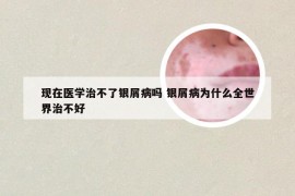 现在医学治不了银屑病吗 银屑病为什么全世界治不好