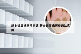 新乡银屑病医院网站 新乡银屑病医院网站官网