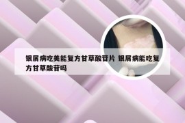 银屑病吃美能复方甘草酸苷片 银屑病能吃复方甘草酸苷吗