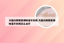 大腿内侧银屑病味道不好闻 大腿内侧银屑病味道不好闻怎么治疗