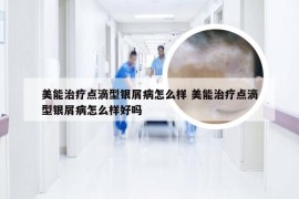 美能治疗点滴型银屑病怎么样 美能治疗点滴型银屑病怎么样好吗