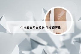 牛皮廨会不会根治 牛皮廨严重