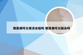 银屑病可以用凉水拍吗 银屑病可以碰水吗