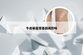 牛皮癣是受基因调控吗