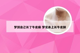 梦到自己长了牛皮癣 梦见身上长牛皮鲜