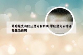 晕痣是先有痣还是先有白斑 晕痣是先去痣还是先治白斑