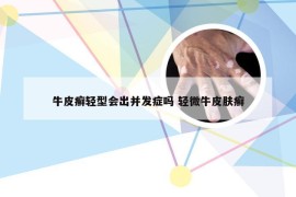 牛皮癣轻型会出并发症吗 轻微牛皮肤癣