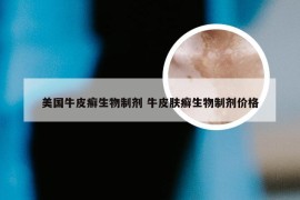 美国牛皮癣生物制剂 牛皮肤癣生物制剂价格