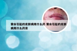 雾水引起的皮肤病用什么药 雾水引起的皮肤病用什么药膏