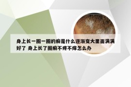 身上长一圈一圈的癣是什么逐渐变大里面满满好了 身上长了圈癣不疼不痒怎么办