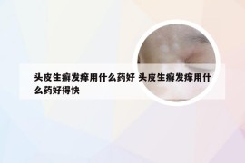 头皮生癣发痒用什么药好 头皮生癣发痒用什么药好得快