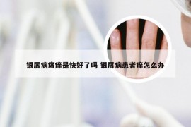 银屑病瘙痒是快好了吗 银屑病患者痒怎么办