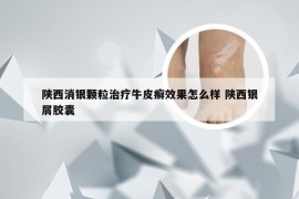 陕西消银颗粒治疗牛皮癣效果怎么样 陕西银屑胶囊