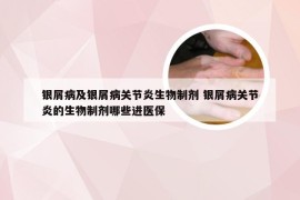 银屑病及银屑病关节炎生物制剂 银屑病关节炎的生物制剂哪些进医保