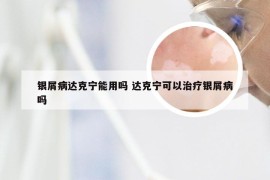 银屑病达克宁能用吗 达克宁可以治疗银屑病吗