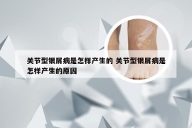 关节型银屑病是怎样产生的 关节型银屑病是怎样产生的原因