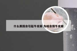 什么原因会引起牛皮藓 为啥会得牛皮廨