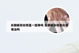 白颠疯和白斑是一回事吗 白颠疯白班很白很难治吗