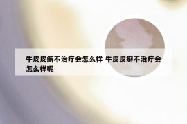 牛皮皮癣不治疗会怎么样 牛皮皮癣不治疗会怎么样呢