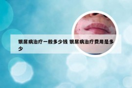 银屑病治疗一般多少钱 银屑病治疗费用是多少