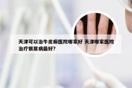 天津可以治牛皮癣医院哪家好 天津哪家医院治疗银屑病最好?