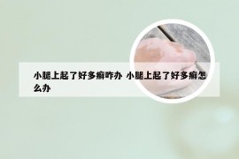 小腿上起了好多癣咋办 小腿上起了好多癣怎么办