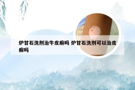 炉甘石洗剂治牛皮癣吗 炉甘石洗剂可以治皮癣吗