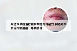 阿达木单抗治疗银屑病打几针起效 阿达木单抗治疗银屑病一年的价格