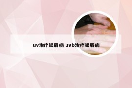 uv治疗银屑病 uvb治疗银屑病