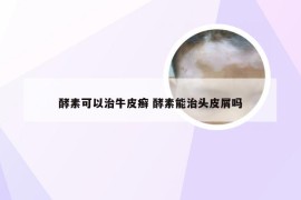 酵素可以治牛皮癣 酵素能治头皮屑吗