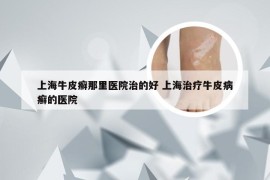 上海牛皮癣那里医院治的好 上海治疗牛皮病癣的医院