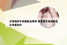 才发现的牛皮癣能治育吗 刚发现牛皮肤癣怎么快速治疗