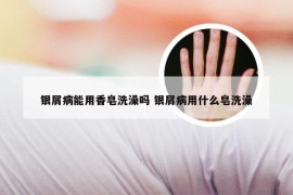 银屑病能用香皂洗澡吗 银屑病用什么皂洗澡