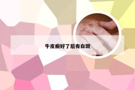 牛皮癣好了后有白斑