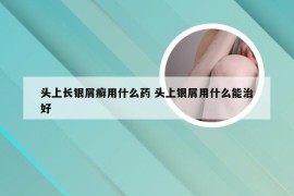 头上长银屑癣用什么药 头上银屑用什么能治好