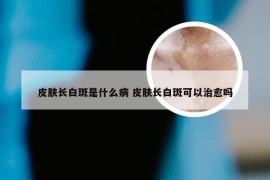 皮肤长白斑是什么病 皮肤长白斑可以治愈吗