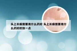 头上长癣需要用什么药好 头上长癣需要用什么药好的快一点