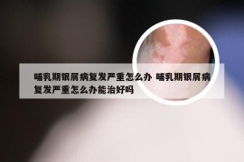 哺乳期银屑病复发严重怎么办 哺乳期银屑病复发严重怎么办能治好吗