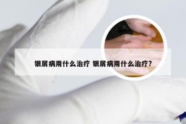 银屑病用什么治疗 银屑病用什么治疗?