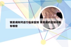 银屑病如何进行临床鉴别 银屑病的鉴别诊断有哪些