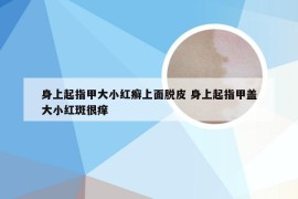 身上起指甲大小红癣上面脱皮 身上起指甲盖大小红斑很痒