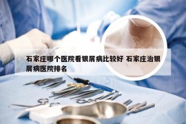 石家庄哪个医院看银屑病比较好 石家庄治银屑病医院排名