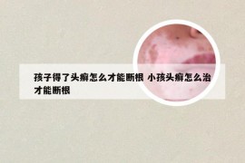 孩子得了头癣怎么才能断根 小孩头癣怎么治才能断根